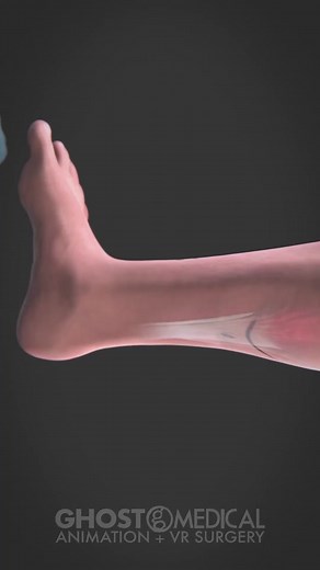 Endoscopic Gastrocnemius Recession Treatment Explained