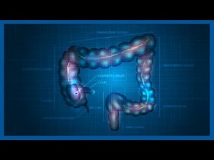 MEGACOLON
