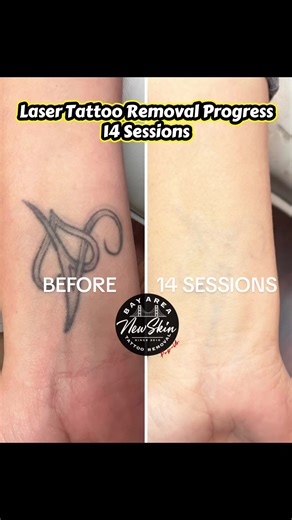 Laser Tattoo Removal progress - Before and After 14 sessions. I asked my patient to take a 6 month break from sessions 12-14 to allow the body TIME to process the remaining ink naturally and not cause trauma from such a high setting on my laser machine. I treated her a 15th time and it should be her last. ⚡️TRUST THE PROCESS because it is a long journey!⚡️ #lasertattooremoval #tattooremovalspecialists #bayareatattooremoval #losangelestattooremoval #sacramentotattooremoval