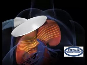 Procedure of Elastography