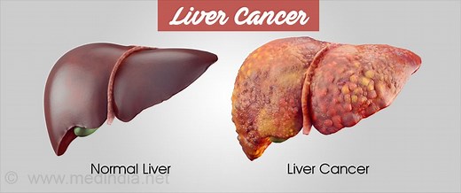 Liver Cancer - Types, Causes, Symptoms, Diagnosis, Treatment, Prevention, Progosis