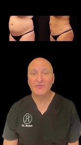 Liposuction Before and Afters