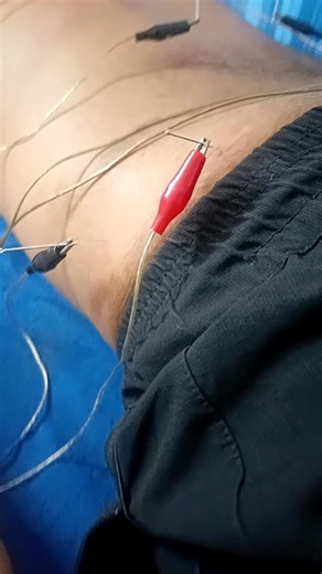 Acupuncture Treatment for Back Pain | Natural Pain Relief