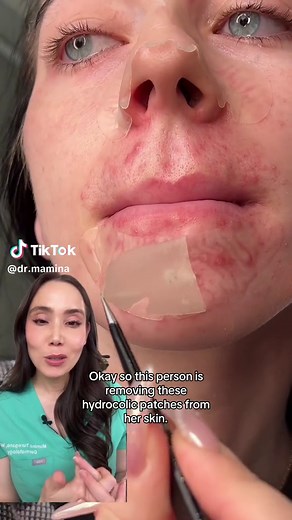 Hydrocolloid patches are here to stay. They were first used for wounds because of their ability to draw in fluid and create a sealed moisture barrier. I don't think hydrocolloid patches work on all forms of acne, but it can be good for a juicy one that is inflamed or if you just want to hide the bump 🤷🏻‍♀️ #acne #acnepatch #hydrocolloidpatch #acnetreatment #dermatologist #drmamina #acnemarks #pimplepopping #satisfying