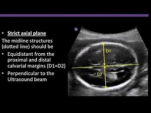 TMT: FETAL IMAGING: Imaging The Lateral Ventricles | ALPANA JOSHI | Fetal Hydrocephalus