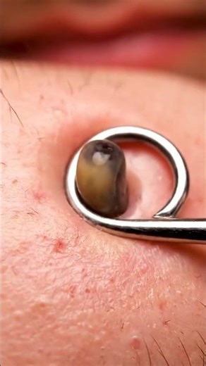 IND-BLOWING Blackhead Removal! 🤯 Pore Extractor Tool #shorts #blackheadremoval #satisfying