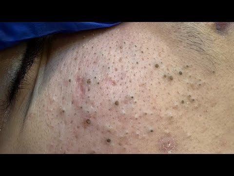 Soko Korean Skincare Routine (For Deep Cleansing & Acne Scar Removal Remedies)