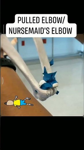 Nursemaid's elbow (AKA radial head subluxation) reduction #pulledelbow