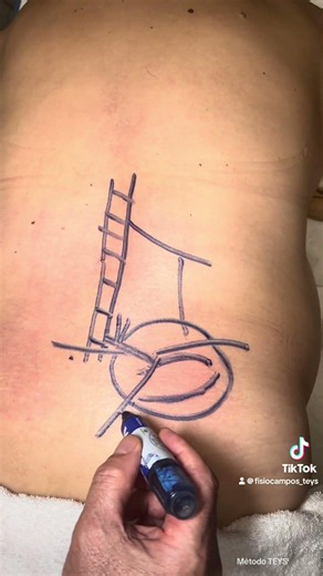 LUMBALGIA, SACROILEITIS, CIÁTICA, ANSIEDAD