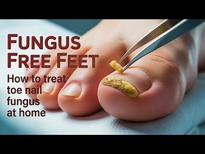 FUNGUS FREE FEET - How to treat toe nail fungus at home: recipe and demo!