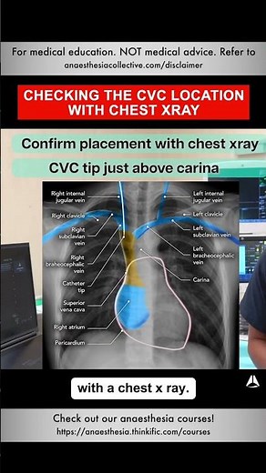 Checking the CVC Location With Chest X-Ray | #shorts #cvc #anesthesiology #nurse