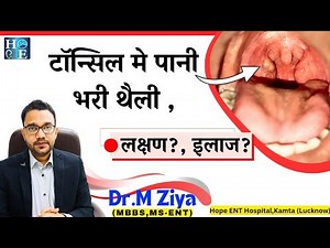 Tonsillar Cyst. टॉन्सिल के ऊपर पानी की थैली|