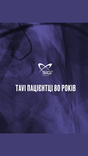 До Інституту Серця звернулася киянка, 80 років, з сильними болями за грудиною та задишкою💔 Обстеження показало: критичний стеноз аортального клапана, ураження коронарних артерій і виражена тромбоцитопенія – кров майже не згортається. За міжнародними шкалами ризику (Euroscore 10,54%, STS score 27,1%) відкрита операція була надто небезпечною. Консиліум лікарів прийняв рішення: стентування коронарних артерій та TAVI – заміна клапана через невеликий прокол, без розтину грудної клітки. В межах одніє