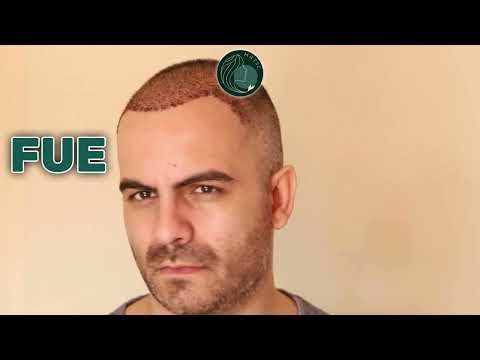 FUE vs FUT Hair Transplant Explained | Cost, Scars & Results | Which Is Right for You?