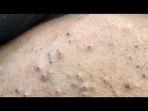 Plastic Surgeon Shares BEST Acne Treatment Methods