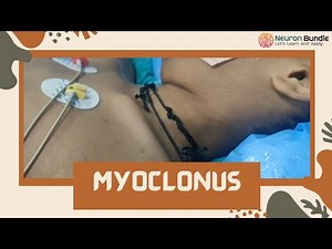 Myoclonus ( a case of #SSPE ) #myoclonicjerks #seizures #measles