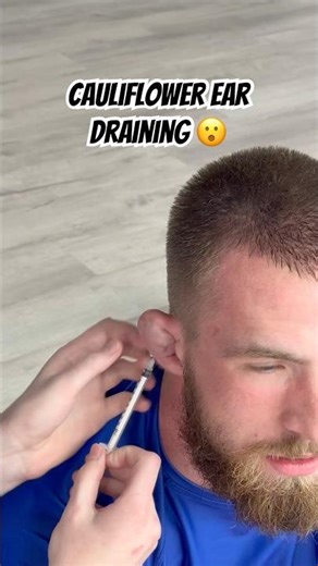 Draining cauliflower ear from jiu jitsu #bjj #mma
