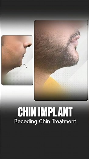 Get a Sharper Jawline 🔥 Chin Implant Before & After #shortsfeed