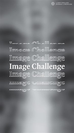 NEJM on Instagram: "A 21-year-old woman who had presented to the pulmonary clinic with a 7-day history of sore throat and cough was noted to have a vertebral abnormality on chest radiograph. She reported no history of back pain. Computed tomography of the chest is shown. What is the most likely underlying etiology? Submit your answer at NEJM.org (link in bio)."