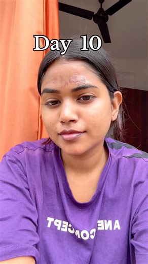 Face burn recovery ❤️‍🩹