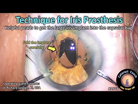 CataractCoach 1568: technique for artificial iris prosthesis