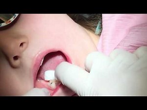 Advantage Arrest - Silver Diamine Fluoride : Pediatric Application | Dr. Jeanette MacLean, DDS
