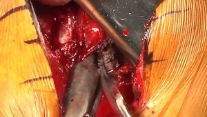 Surgical Technique and Pearls: Subscapularis-Sparing Windowed Anterior Technique (SWAT) TSA