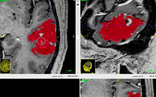 神外学影像1：用ITK-SNAP画感兴趣区域（ROI）