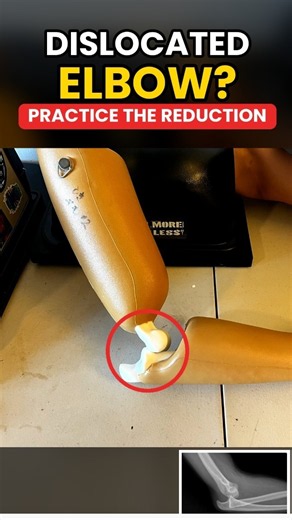 Dislocated Elbow? Practice the Reduction Before Game Day 💪 #athletictraining