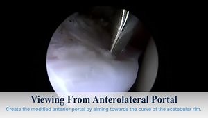 Safe, Quick, and Easy Periportal Creation For Hip Arthroscopy