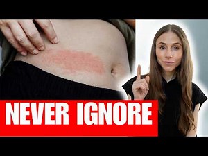 Dermatologist Explains Rashes That Should NEVER Be Ignored