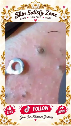 Deep Blackhead Extraction & Satisfying Popping | Wait for the most satisfying pop 😳🫣 You won’t believe what comes out! #pimplepoppersatisfying #Acne #pimple #Blackhead #Satisfying