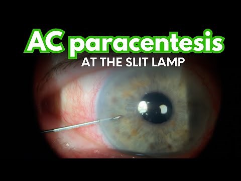 Anterior Chamber Paracentesis - HOW TO to quickly and safely lower elevated eye pressure