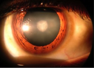Native Stem Cells Regrow Human Lenses, Vision Restored | Clinical And Molecular Dx