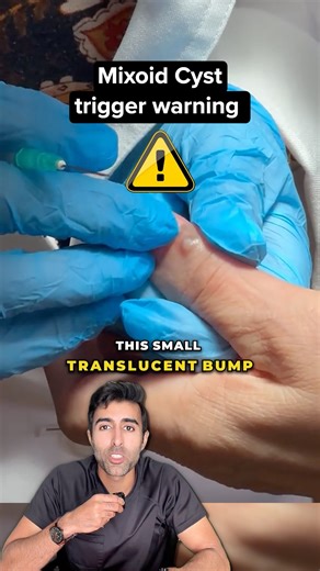 Kunal Sood, MD on Instagram: "Digital myxoid cysts often connect to the joint beneath them, MRI can even show the tiny canal linking cyst to joint in most cases. If one bursts on its own, the risk of joint infection rises sharply, which is why removal is sometimes advised. 💡 VC: @doctorlargestorgan, @drdanilkovitch Follow @doctorsoood to improve your health IQ and for similar content. #mixoidcyst #cyst #orthopedics #arthritis #dermatology #healthtips #health #medical"