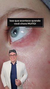 Você sabia que o choro pode afetar a pele ao redor dos seus olhos? 😢 Devido à alta concentração de sal, as lágrimas podem ressecar e irritar a pele quando há contato frequente, especialmente na região sensível ao redor dos olhos. Além disso, o atrito causado ao esfregá-los durante o choro aumenta a sensibilidade, provocando vermelhidão e desconforto. 🔹 Inchaço e olheiras – O acúmulo de líquido e o aumento da circulação sanguínea podem deixar a região inchada e escurecida. 🔹 Pele ressecada – A