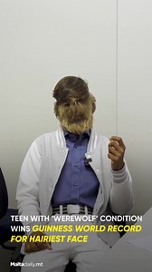 An 18-year-old teenager from India, Lalit Patidar, has set a Guinness World Record for the hairiest face, due to his rare condition, hypertrichosis. This condition causes excessive hair growth across the body, and in Patidar’s case, it has led to 95% of his face being covered in hair. He was awarded the record in February for having 201.72 hairs per square centemeter on his face. Patidar, who has faced teasing and fear from others in the past, expressed his joy at the recognition, saying he was 