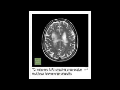 Progressive Multifocal Leukoencephalopathy (PML)