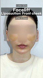 Procedures that complement a facelift: front cheek liposuction #facelift #koreaplasticsugery