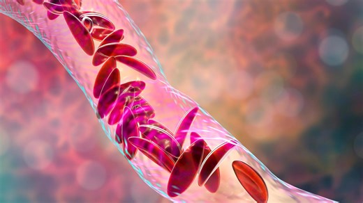 MDHHS unveils new plan to break down barriers for sickle cell disease patients in Michigan