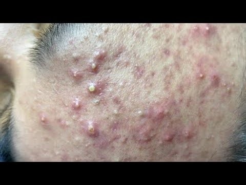 Relaxing Skincare Routine: Deep Pore Cleansing for a Peaceful Mind #202611