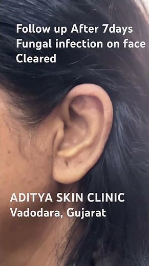 Fungal infection on face — cleared in just 7 days ✅