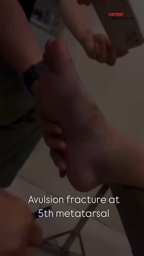 44 reactions · 40 shares | Avulsion fracture at the 5th metatarsal?...