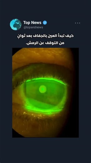 TopandNews on Instagram‎: "ما تراه في هذا الفيديو ليس تأثيرًا بصريًا… بل بيولوجيا حقيقية تُظهر كيف تبدأ العين بالجفاف بعد ثوانٍ من التوقف عن الرمش. الاختبار يُعرف باسم **Tear Break-Up Time**، حيث يُستخدم صبغ فلوريسنت آمن ليُظهر طبقة الدموع وهي تنتشر على سطح العين ثم تبدأ بالتبخر تدريجيًا. هذه الطبقة الرقيقة من الدموع تُعتبر خط الدفاع الأول: - تُحافظ على وضوح الرؤية - تُحمي سطح العين من التهيج - تُعيد التوازن مع كل رمشة لكن عندما تتكسر هذه الطبقة بسرعة، يُصبح سطح العين مكشوفًا، مما يؤدي إلى: - جف