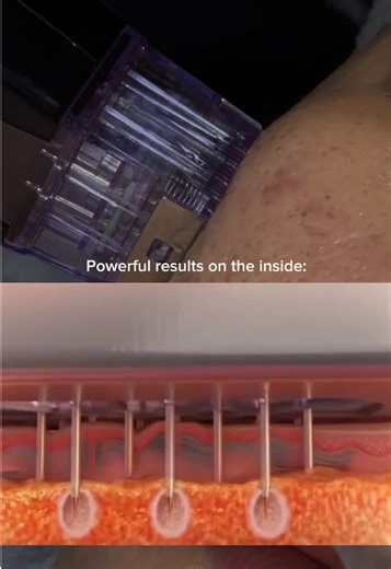 Transform Your Skin with RF Microneedling Treatments