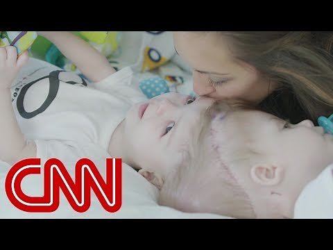 Rare surgery to separate conjoined twins