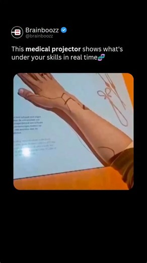 BrainBoozz on Instagram: "Doctors are beginning to see through the human body — without making a single cut. 🩺✨ This medical projection system takes real imaging data (like CT scans or ultrasounds) and projects it directly onto a patient’s body in perfect alignment. Veins, muscles, and internal structures appear exactly where they exist beneath the skin, eliminating the need to constantly look back and forth between screens and the patient. Using precise calibration and motion tracking, the pro
