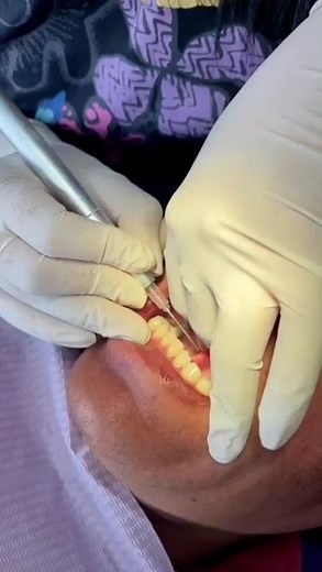 Short lingual frenulum in adults: what they never told you