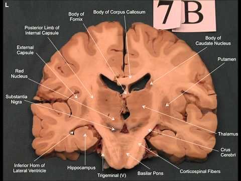 Neuroanatomy - Coronal Brain Slices