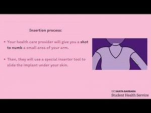 SHS Implant (Nexplanon) Video